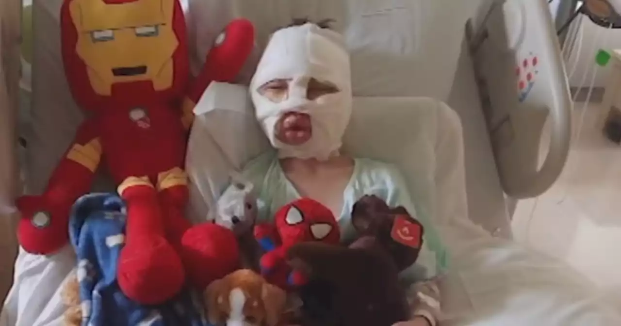 6-year-old Connecticut boy severely burned in alleged neighborhood attack