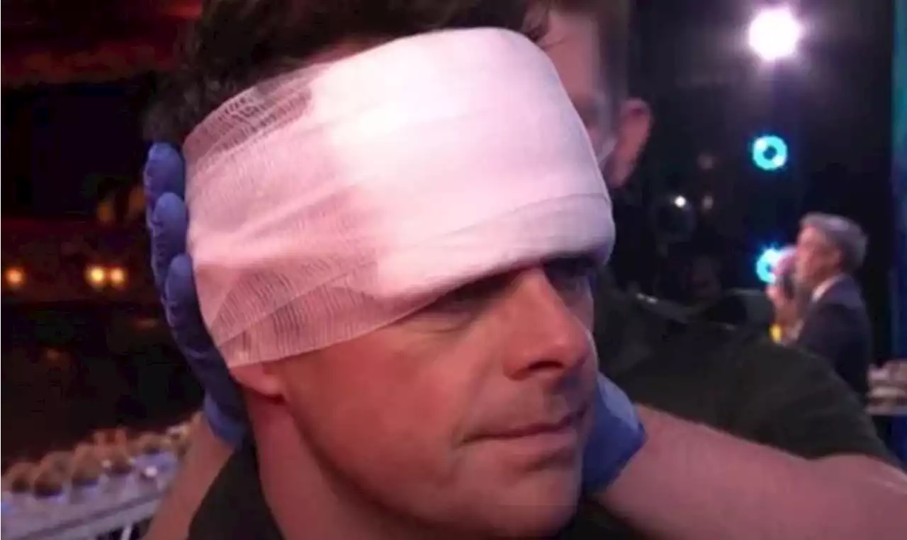 Ant McPartlin bloody and bandaged after smashing head on coconut