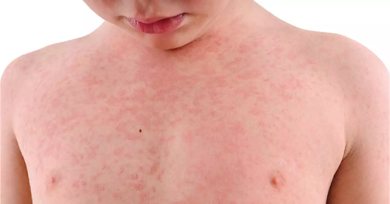 WHO, UNICEF Warn About Increased Risk of Measles Outbreaks