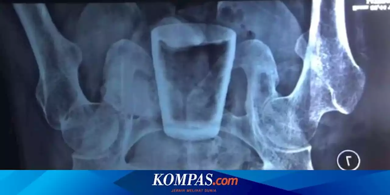 Ada Gelas Kaca di Perut Warga Jember, Tim Dokter Duga Sengaja Dimasukkan Pasien