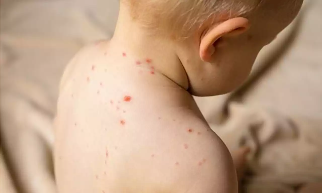 Doctors tell parents to be on guard for chickenpox and scarlet fever