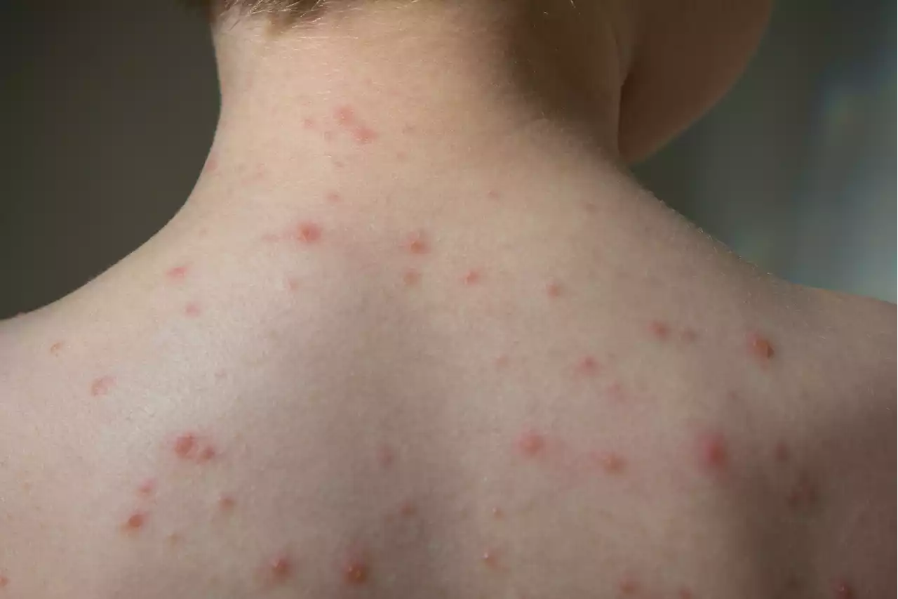 Parents warned of dangerous chickenpox and scarlet fever 'cocktail'