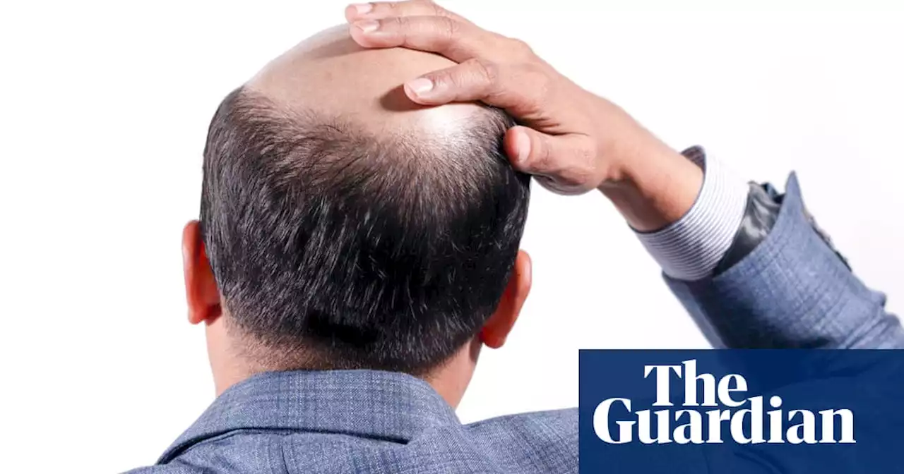 Tell us: share your experiences of anti-bald prejudice