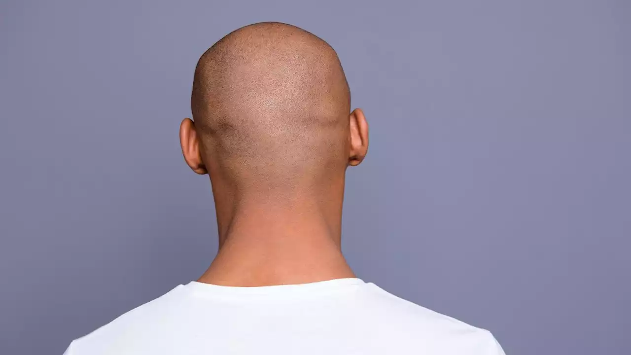 Calling a man bald is sexual harassment, employment tribunal rules