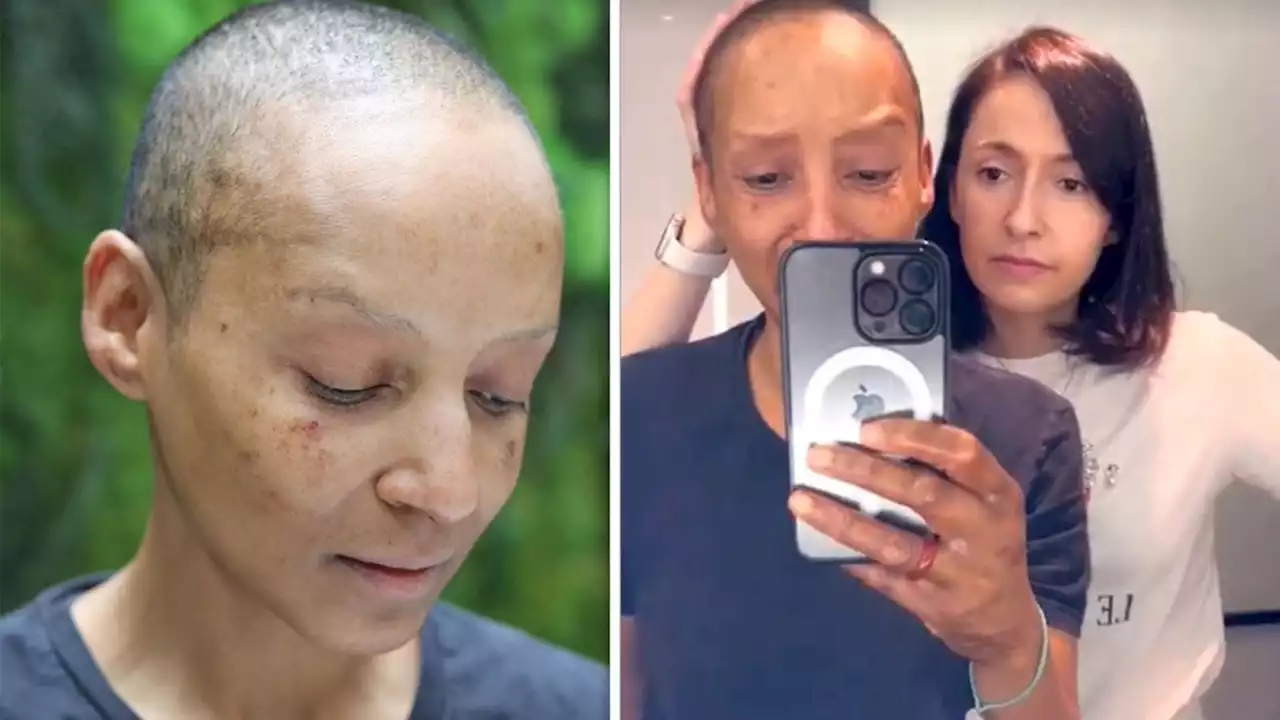 Adele Roberts admits she was ‘ashamed to show face’ after chemotherapy 'burned' her skin