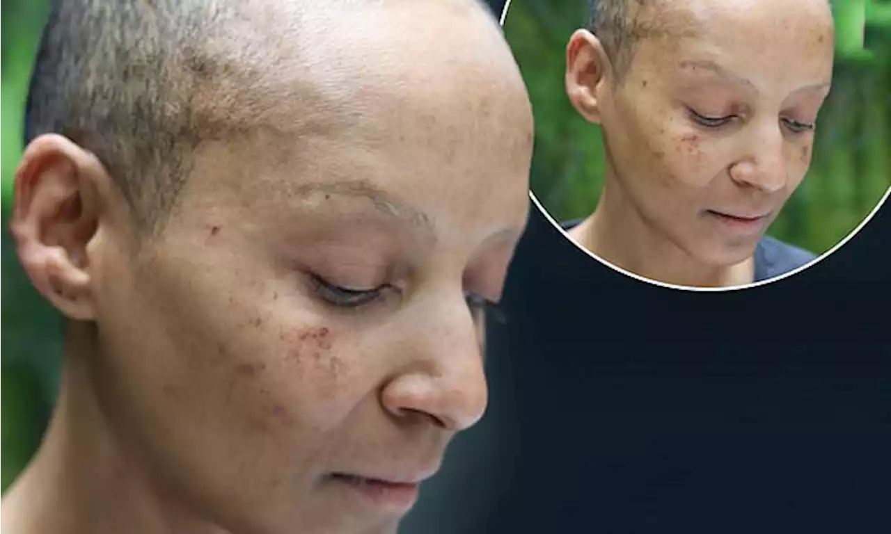 Adele Roberts reveals chemotherapy left her with 'burned' skin