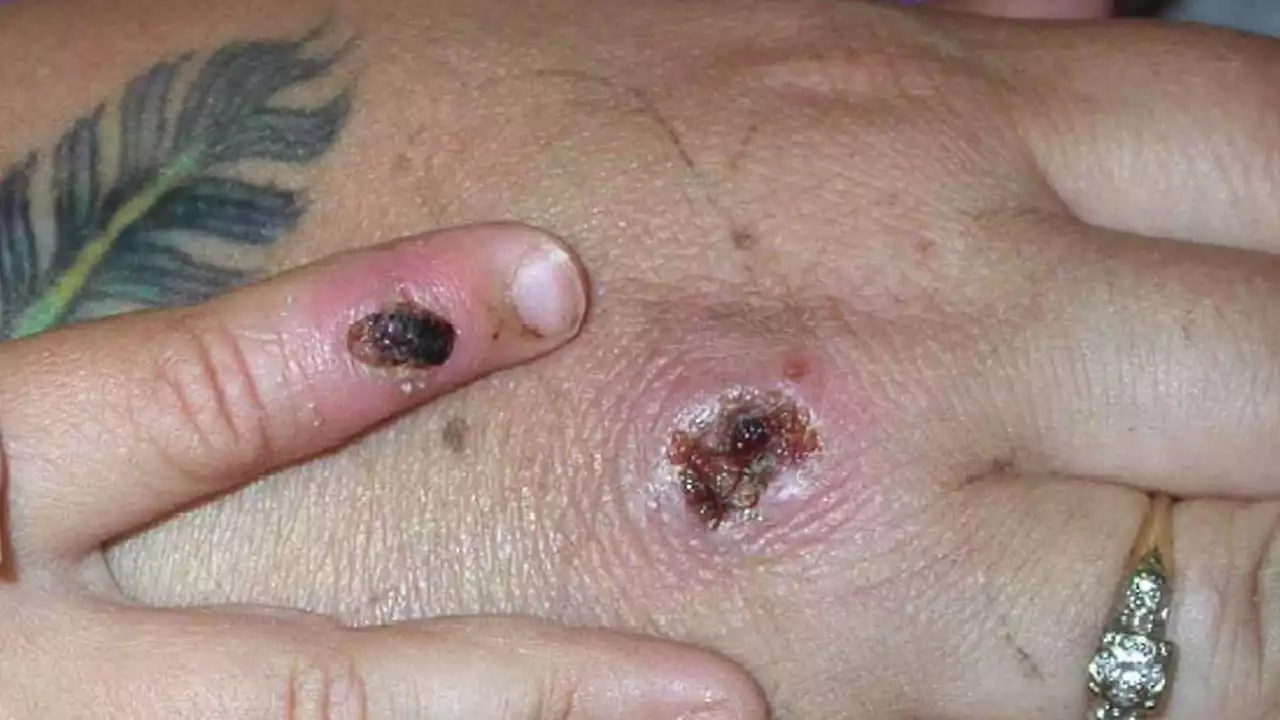 Two cases of rare monkeypox confirmed in London