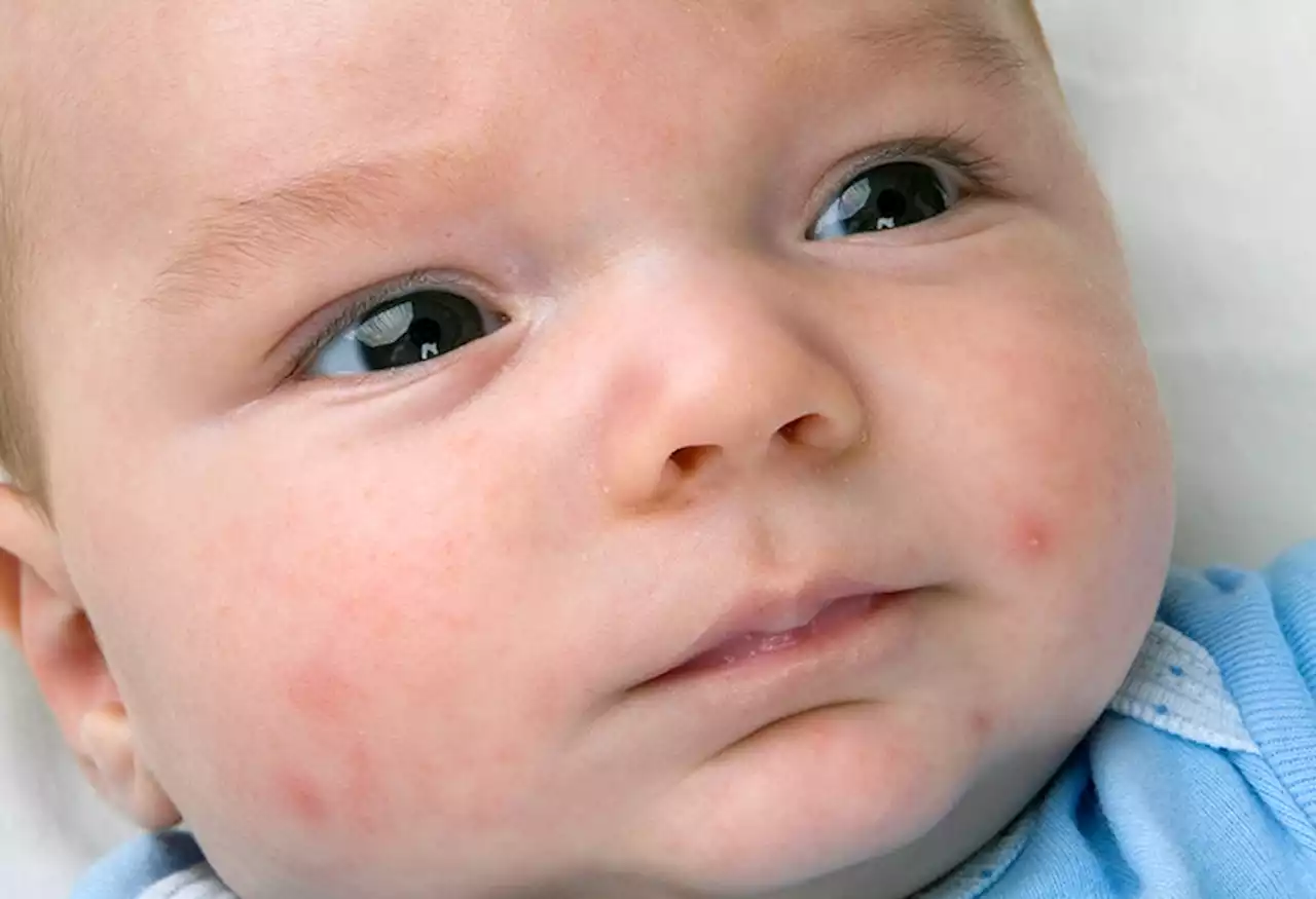 A guide to baby rashes and how to work out the cause