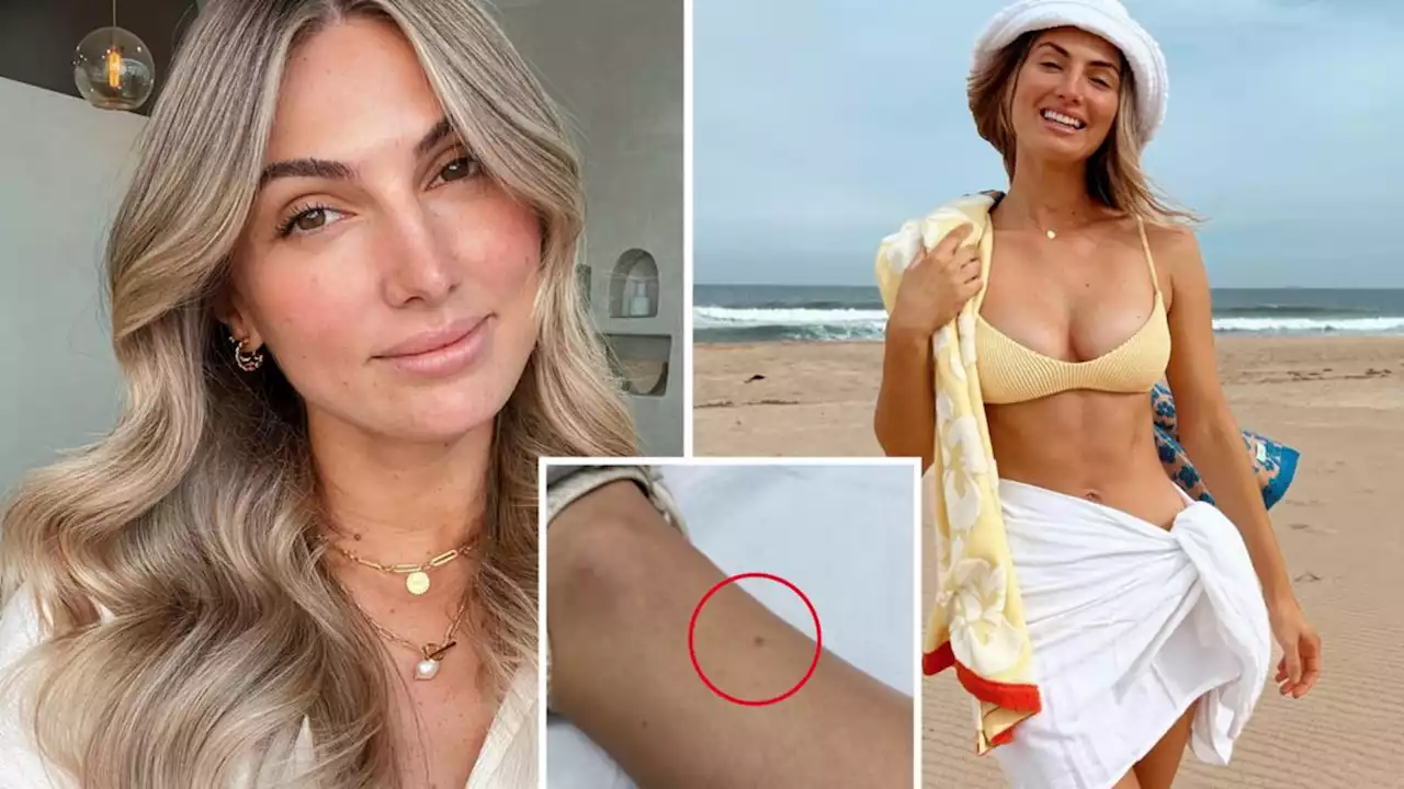 Aussie model shares warning signs after tiny find led to sinister diagnosis