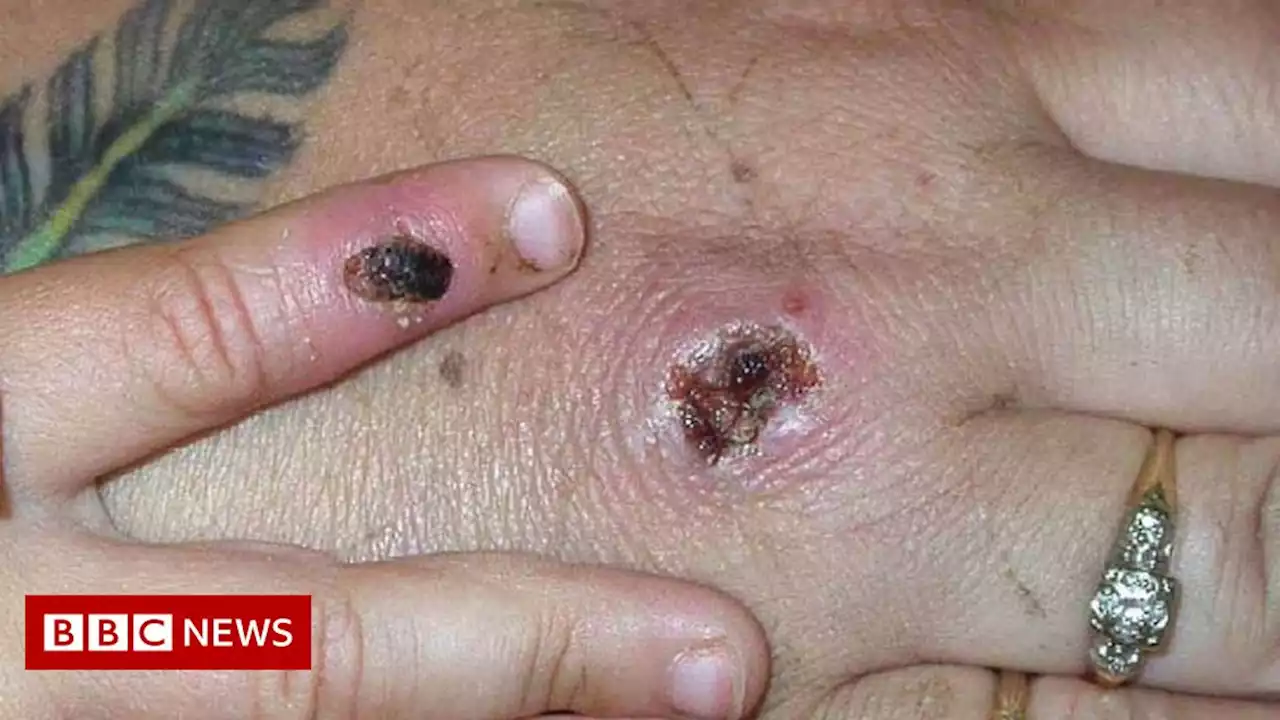 Monkeypox: Two more people infected to take total to nine in UK