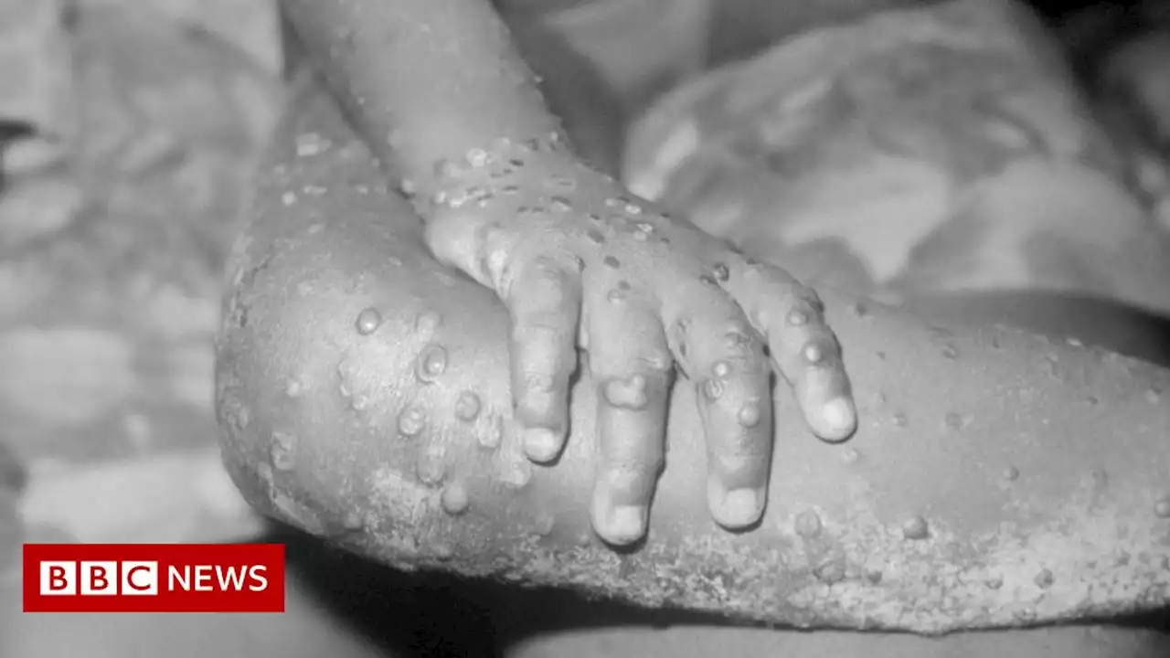 Monkeypox: Plans in place to stock up on treatments if infections rise