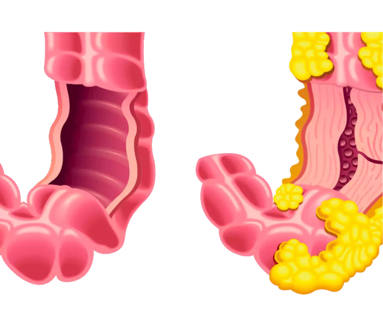 Ojo con la Enfermedad Inflamatoria Intestinal