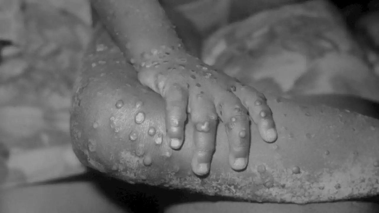 Monkeypox: Here's everything you need to know about the virus in Europe