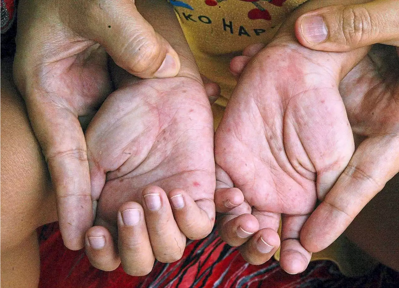 HFMD cases in Selangor still under control, says MB