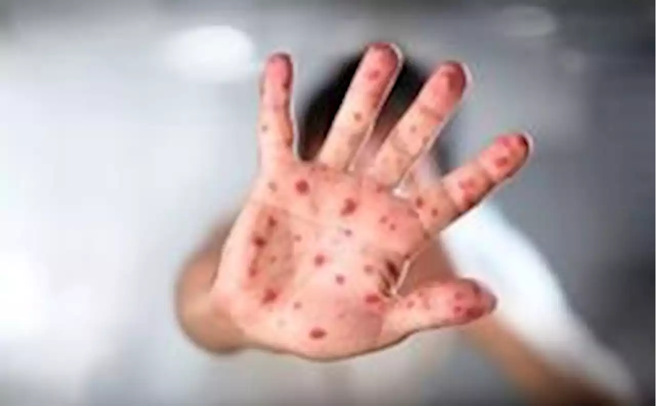 HFMD: Nurseries the main vector for outbreaks, says Johor health exco