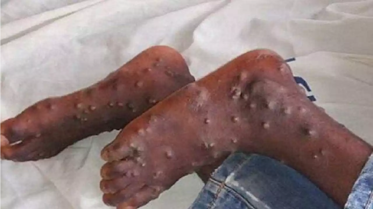 WHO Keluarkan Peringatan soal Munculnya Virus Monkeypox Mematikan di Inggris - Tribunnews.com