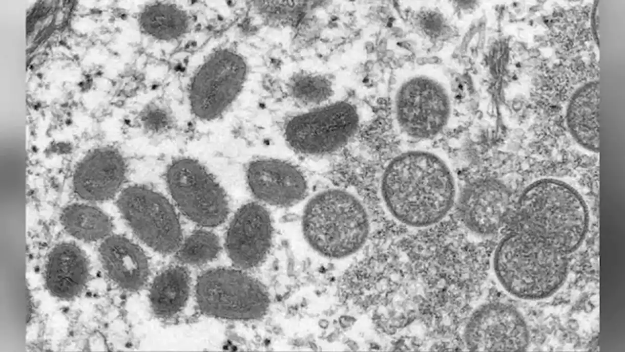 1st monkeypox case in US this year reported in Massachusetts, health officials confirm