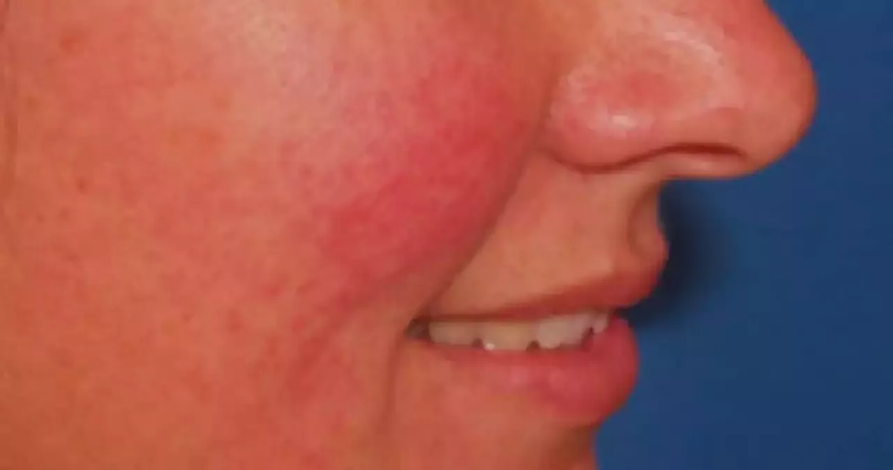 What Is Rosacea Expert Advice On Your Red Skin Spots Rashes And Lumps Singapore Head Topics