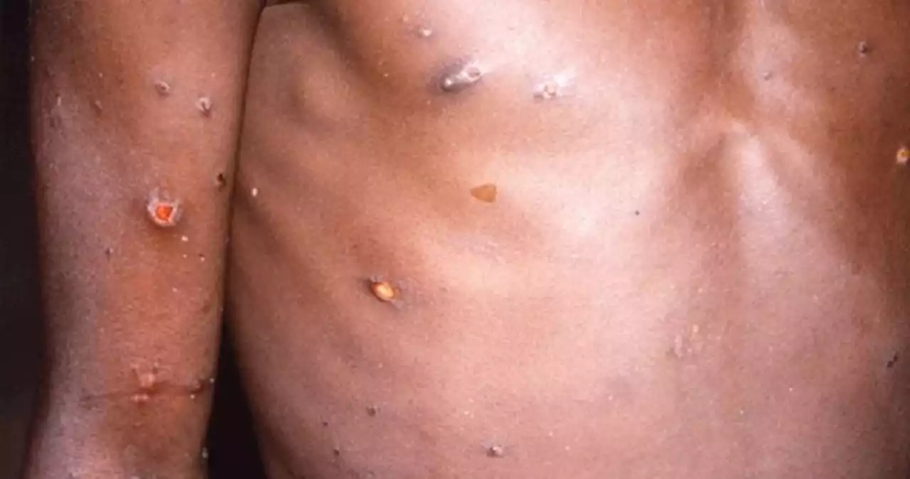 Why monkeypox cases are rising in Europe