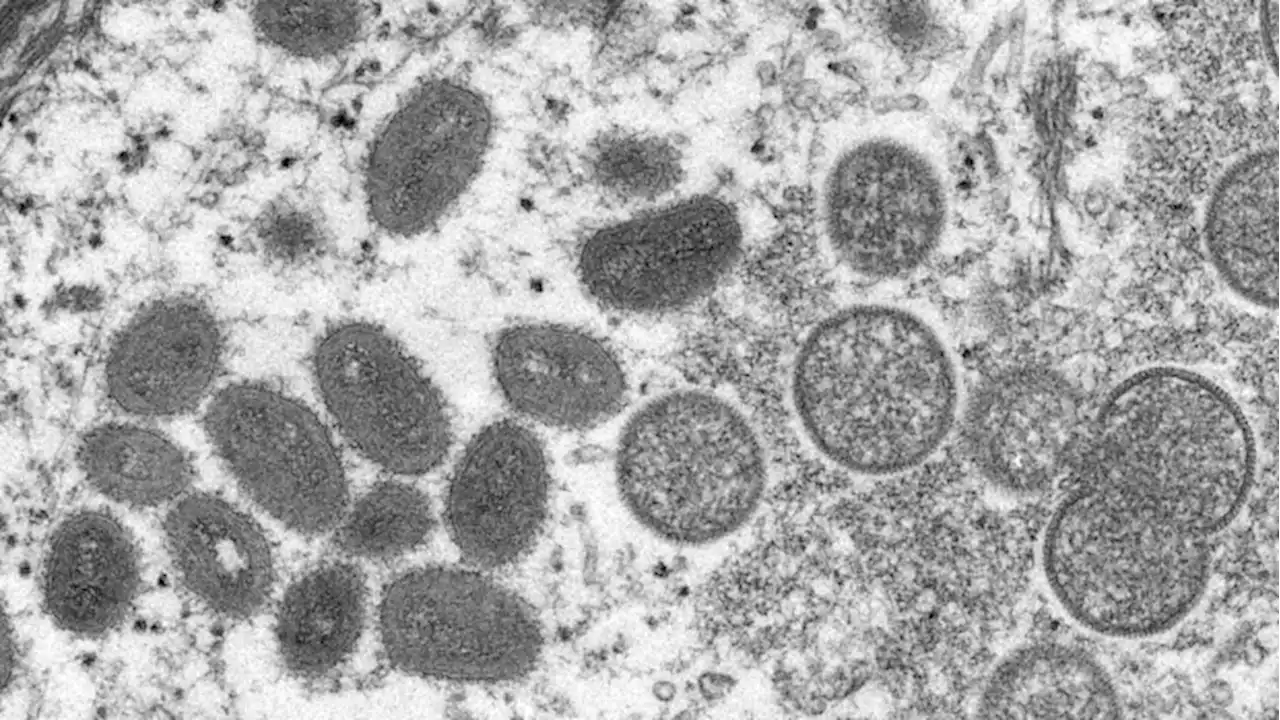 Monkeypox cases under investigation in Canada as outbreak spreads in Europe, U.S. | CBC News