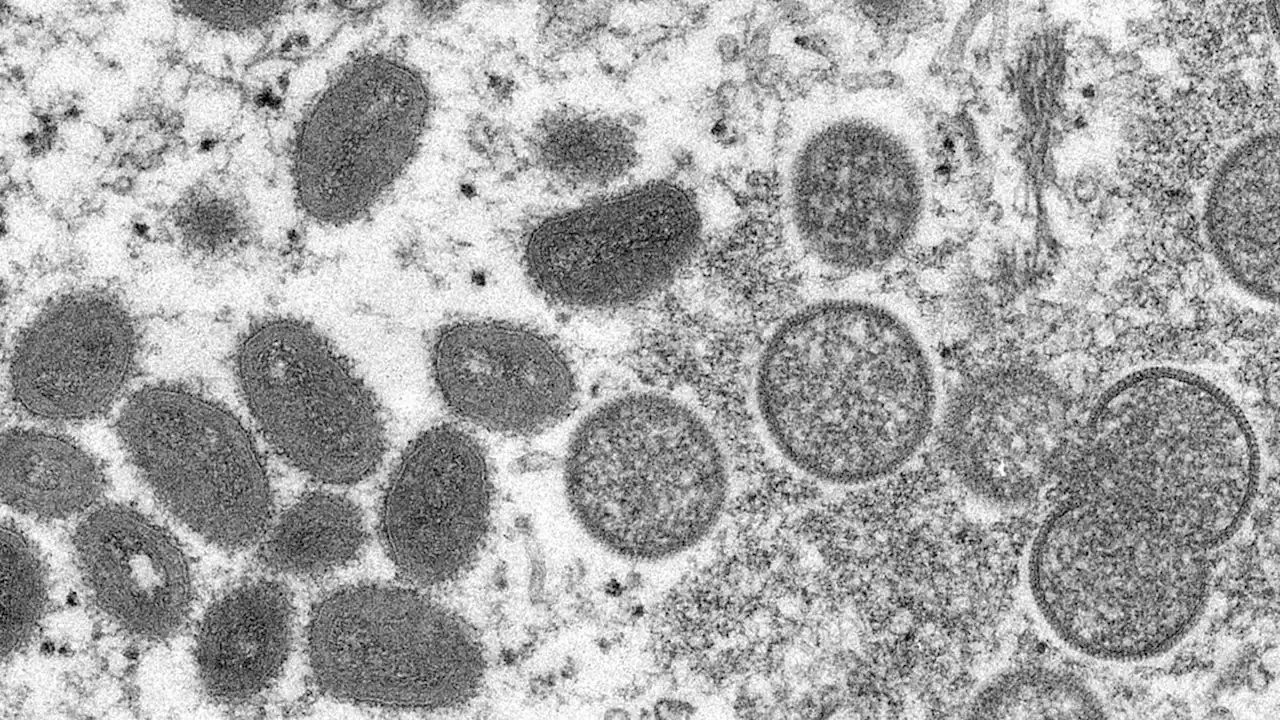 Health officials suspect 17 monkeypox cases in Montreal area