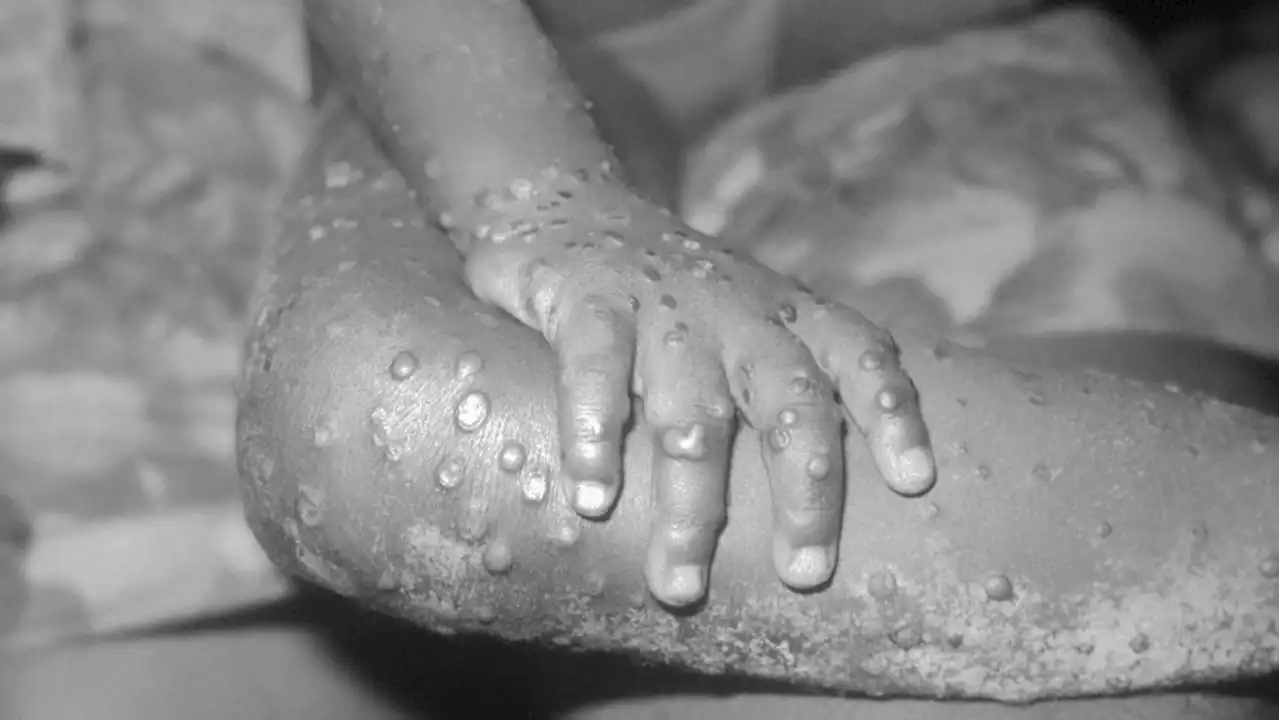 Montreal has 17 suspected monkeypox cases; officials say it's 'not highly contagious' or severe