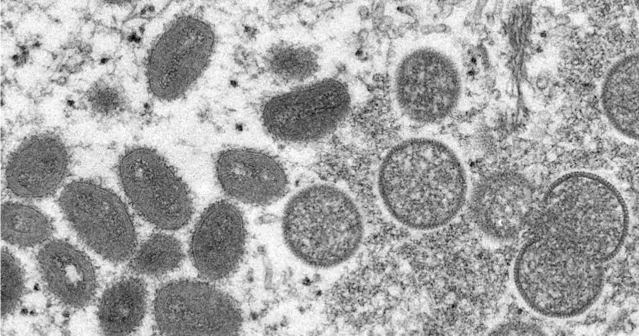 U.S. confirms monkeypox case in man who recently travelled to Canada - National | Globalnews.ca