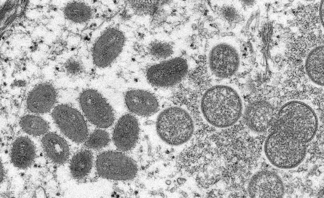 Portugal, Spain detect new cases of monkeypox infection; Italy reports first case