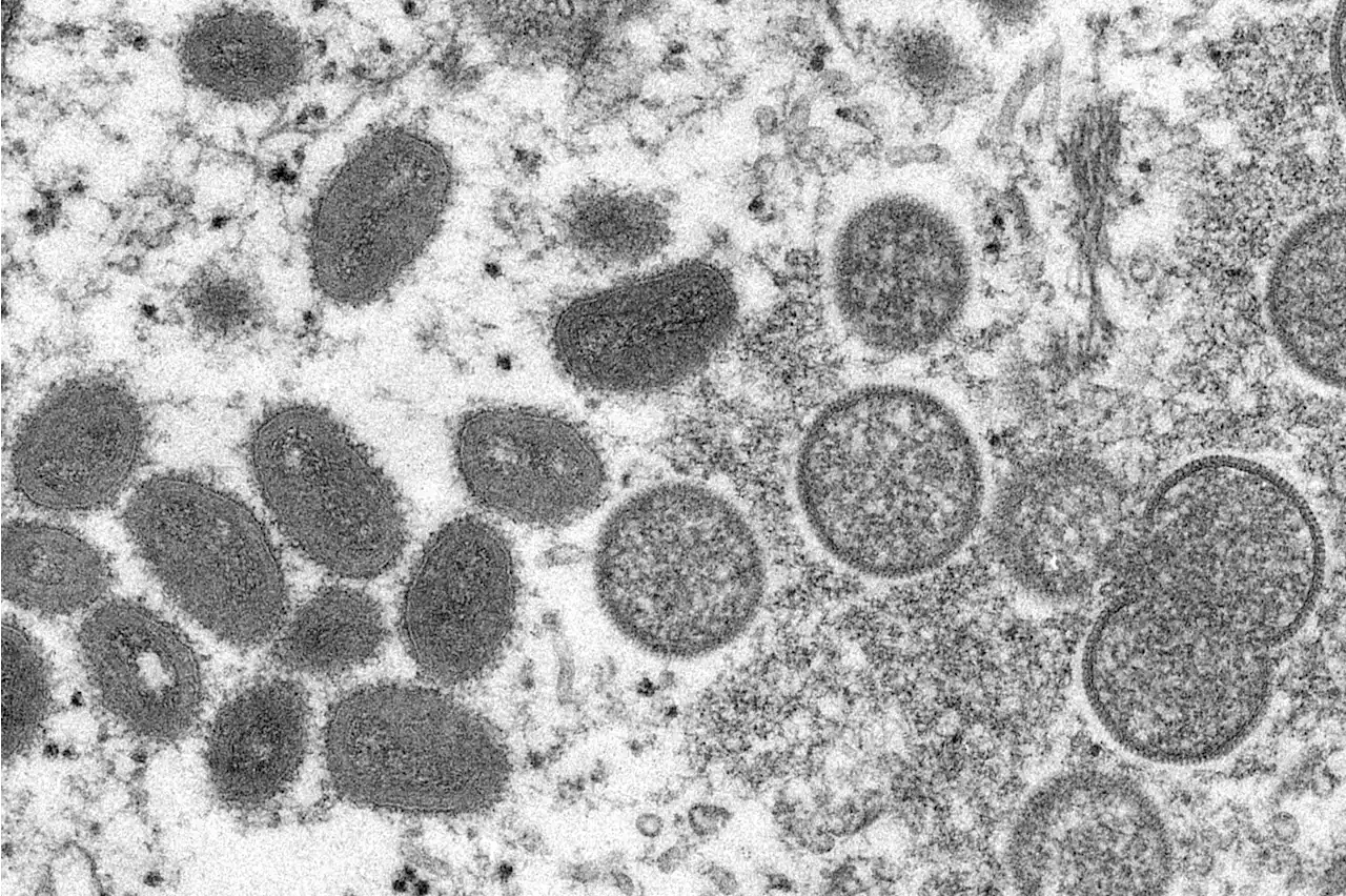 Monkeypox Reported In Massachusetts Man