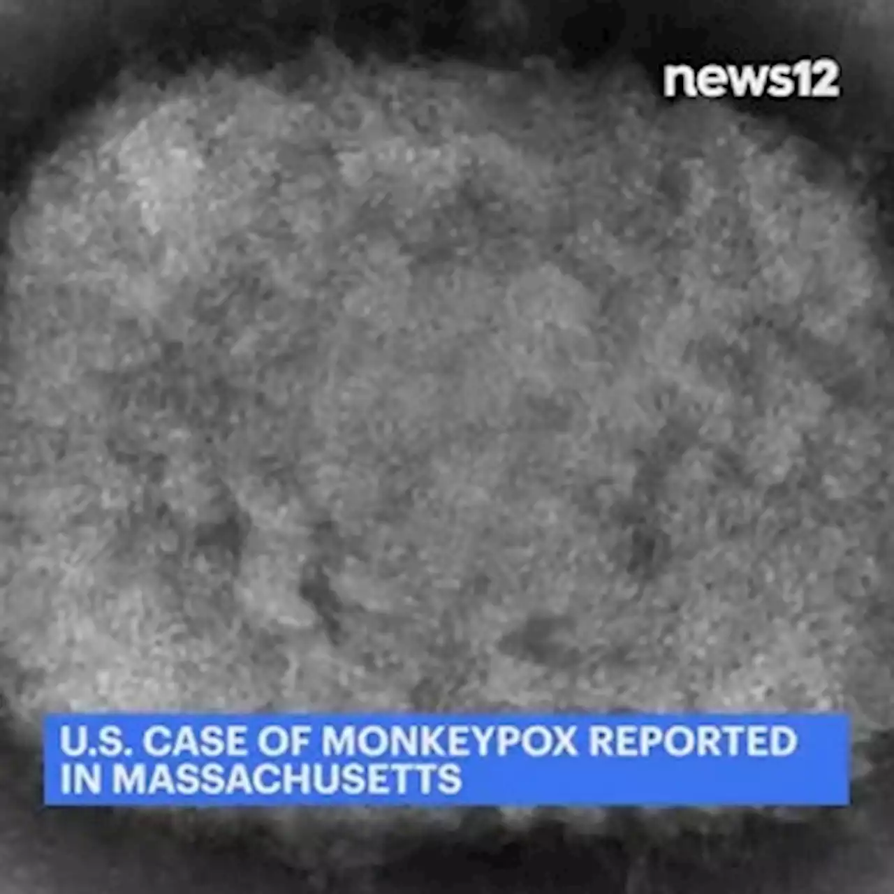 US case of monkeypox reported in Massachusetts man