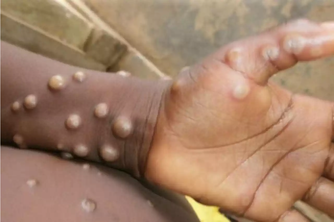 Why monkeypox cases are rising in Europe