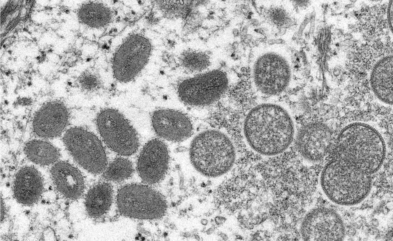 Rare monkeypox case confirmed in Massachusetts