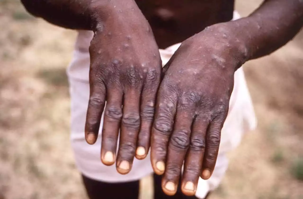 African scientists baffled by monkeypox cases in Europe, US