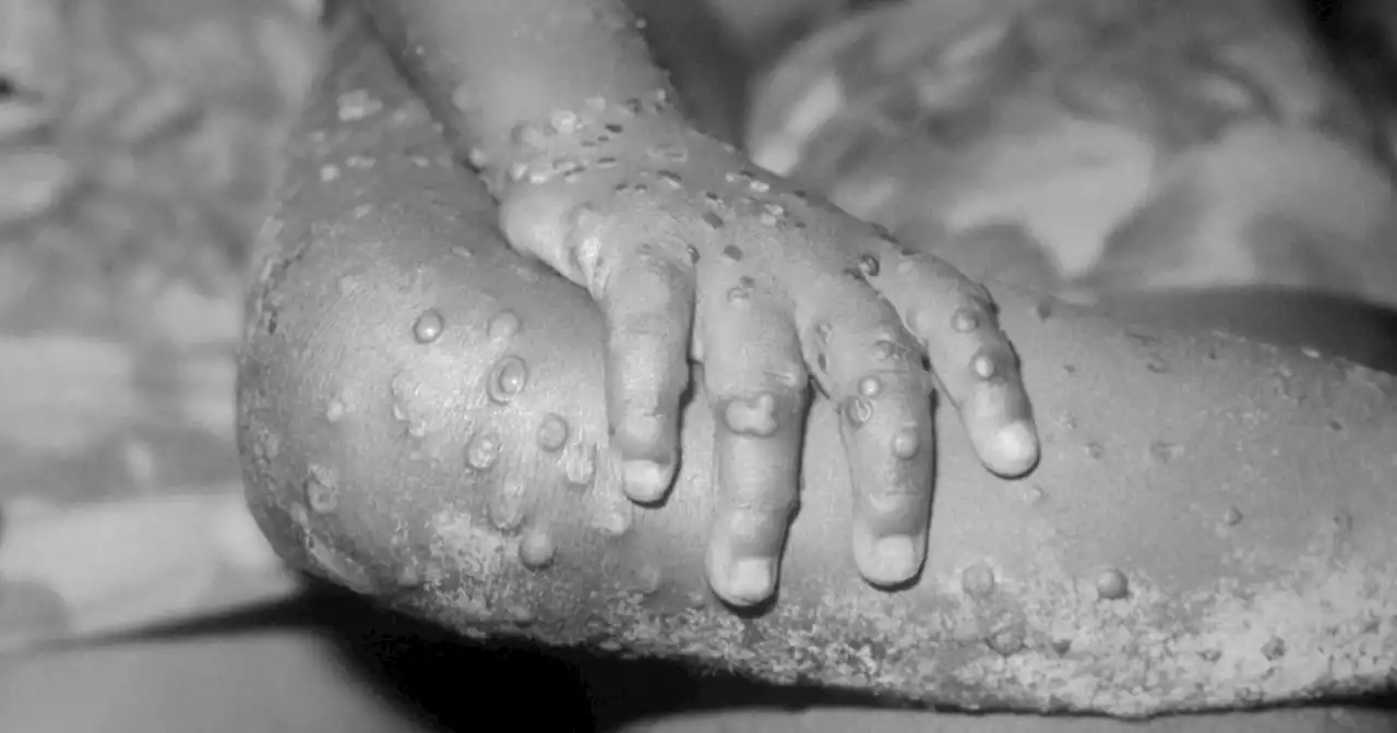 The symptoms and causes of monkeypox, which CDC calls an 'emerging issue'