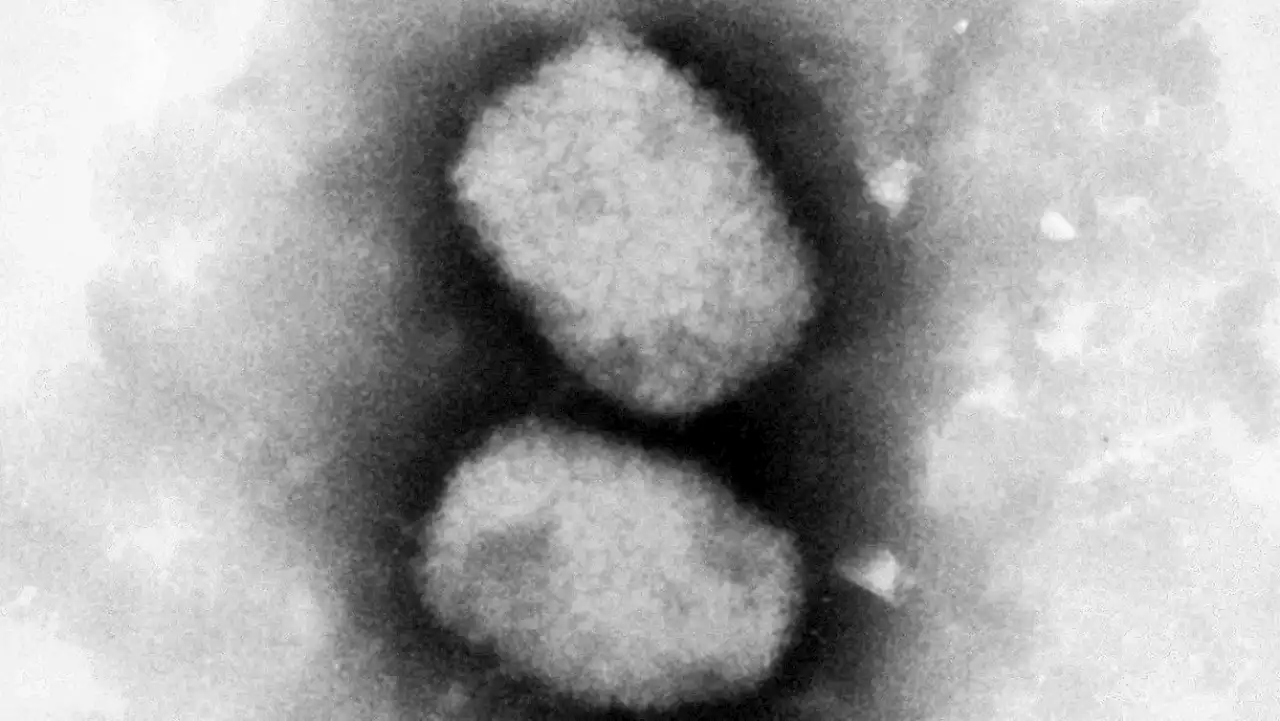 Erster Fall von Affenpocken in Deutschland bestätigt