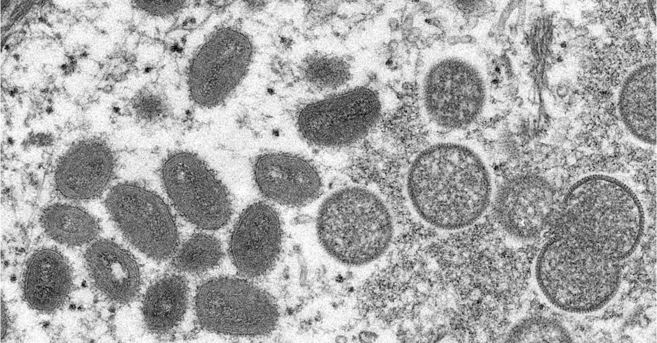 Canada confirms first two monkeypox cases