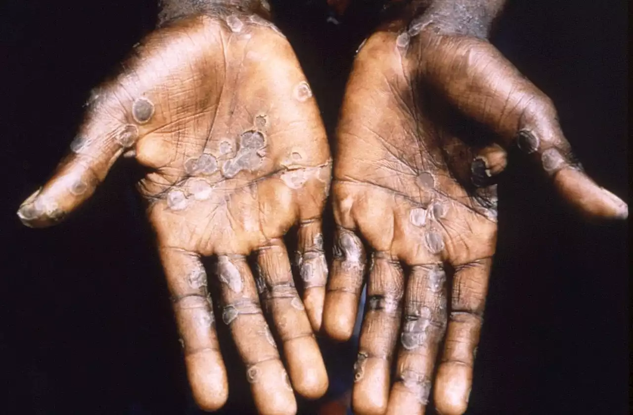 Explainer: What is monkeypox and where is it spreading?