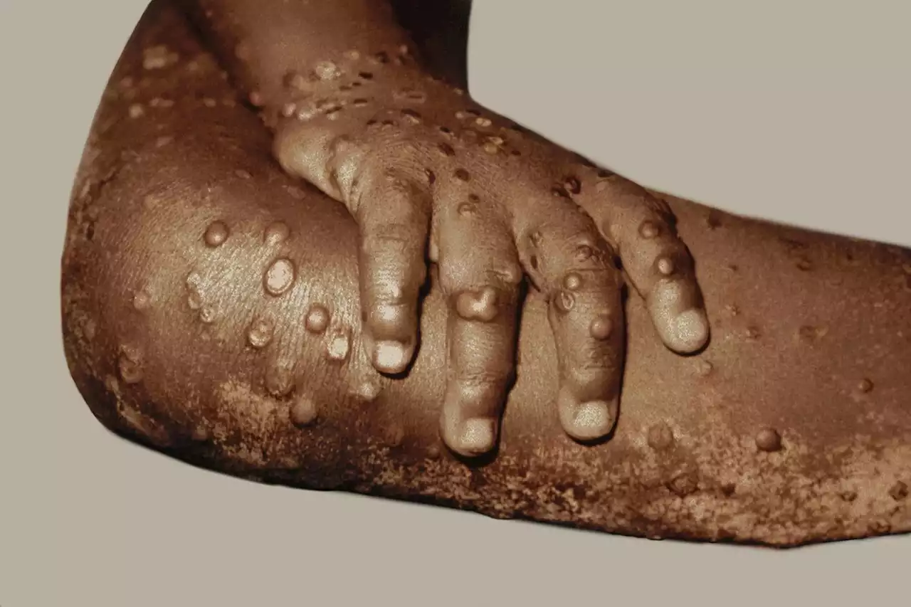 NYC Investigates Possible Case of Monkeypox