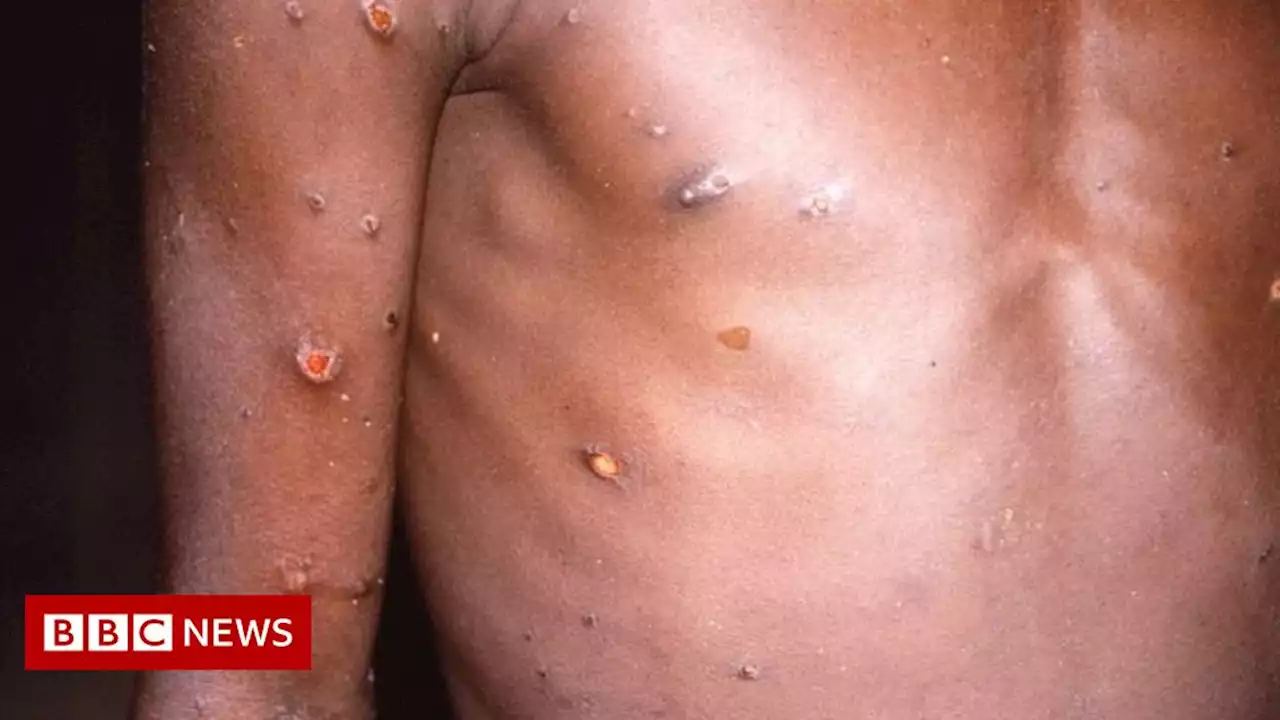 Monkeypox: 80 cases confirmed in 11 countries, says WHO