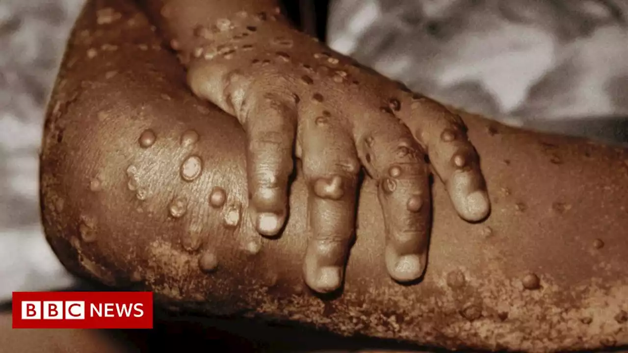 Monkeypox: Time to worry or one to ignore?