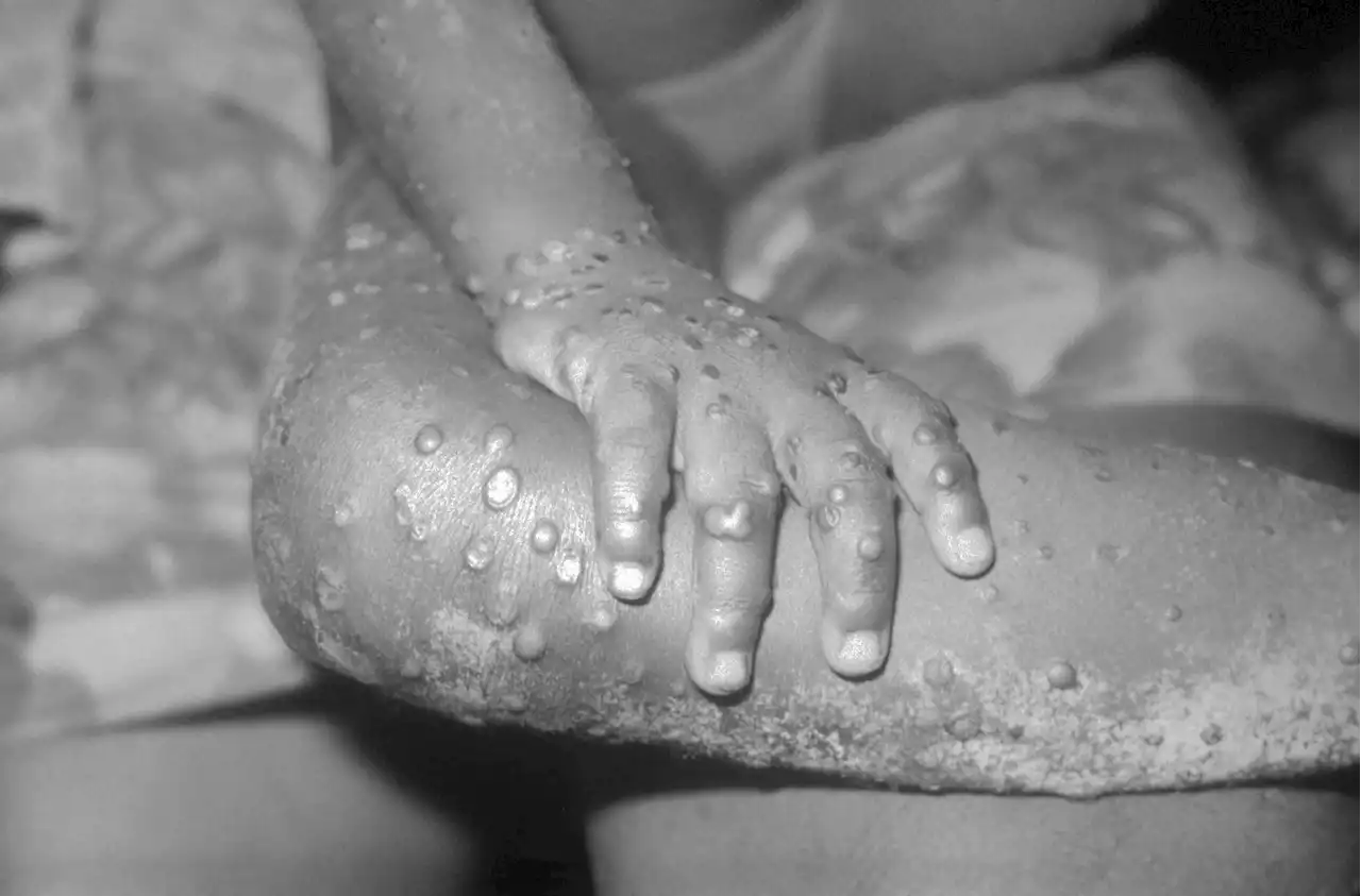 Monkeypox Outbreak Updates: European outbreak differs from transmissions in Africa