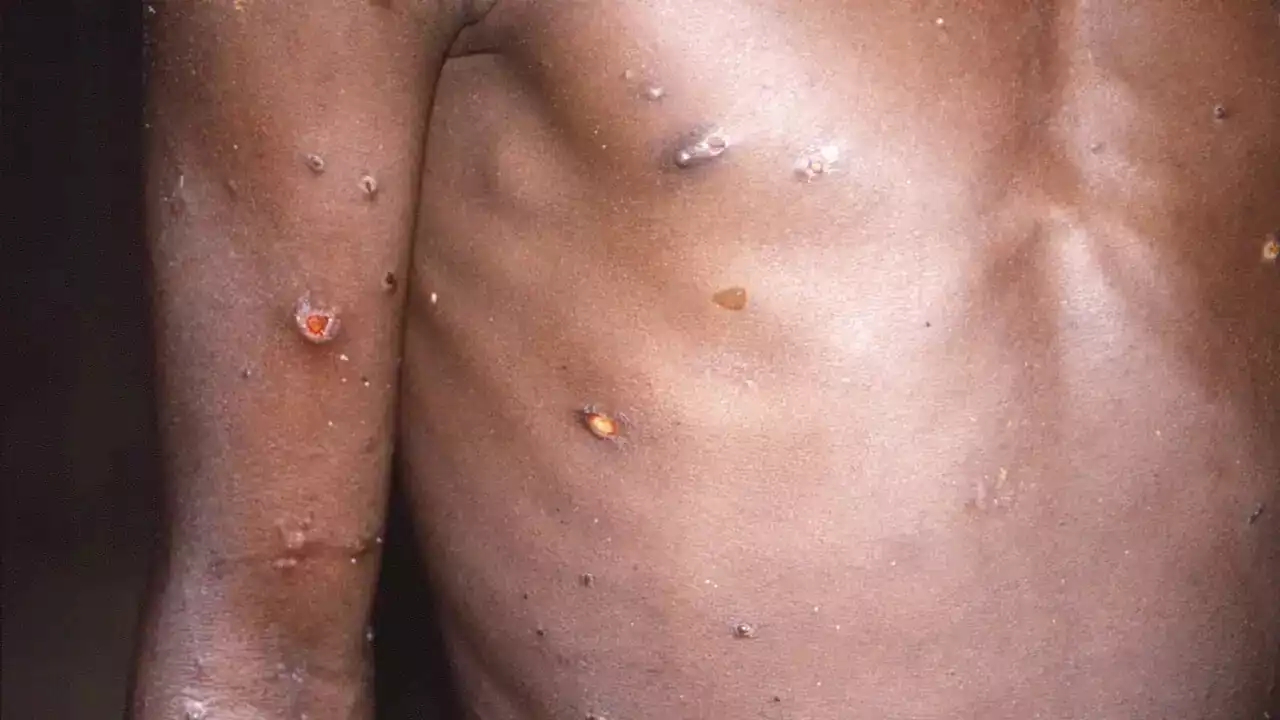 Monkeypox has arrived in Australia: What is it and how can we prevent the spread?