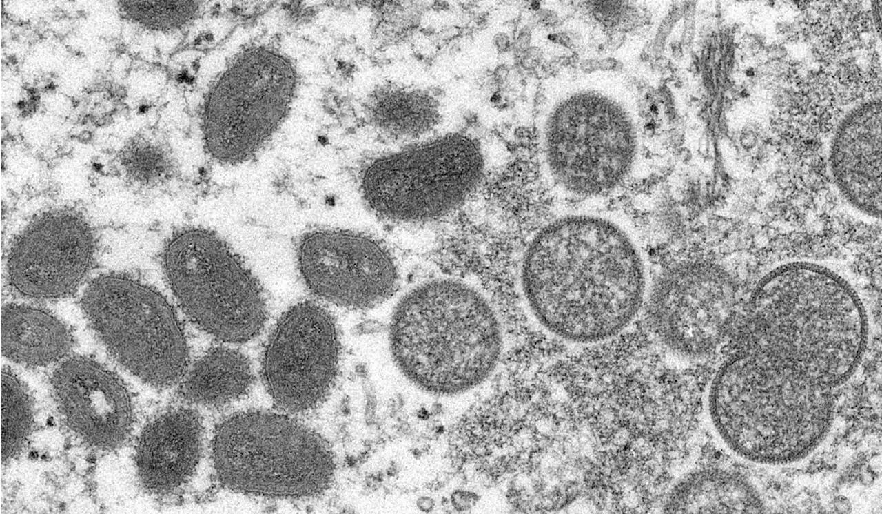 NYC reports a possible case of monkeypox amid strange clusters