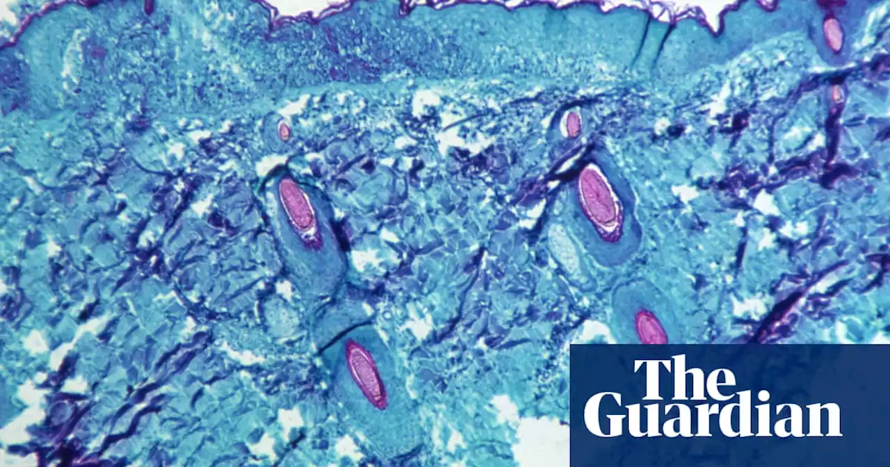 More monkeypox cases detected in UK ‘on daily basis’, says scientist