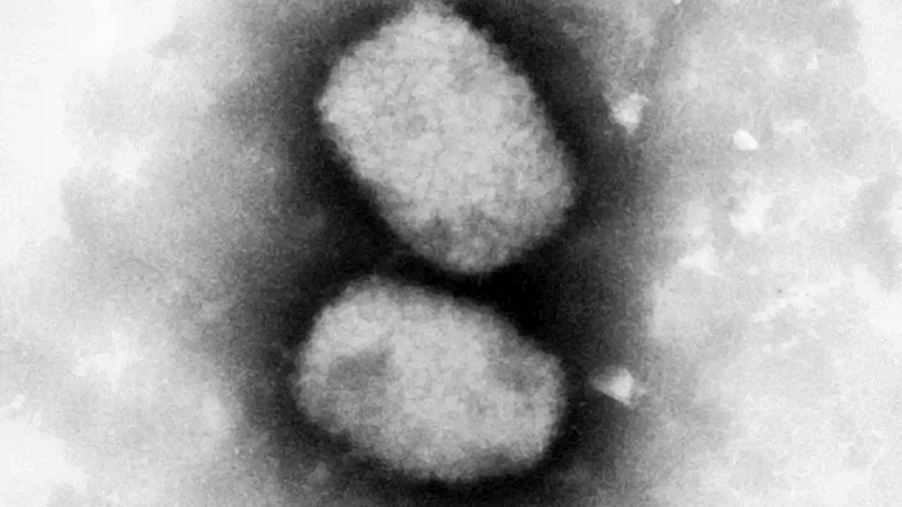 Drei Affenpocken-Kranke in Deutschland — Experten erwarten weitere Fälle