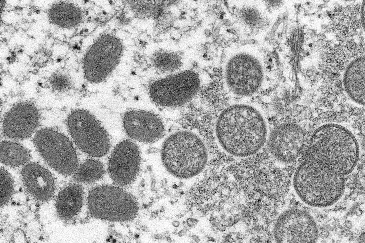 Canadian health officials confirm two cases of monkeypox, investigating a ‘couple dozen’ instances in ‘unusual’ outbreak