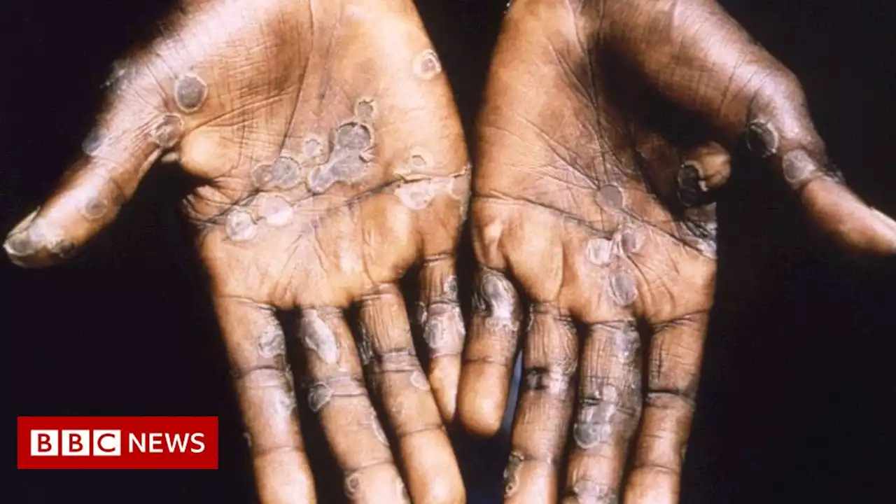 Monkeypox virus outbreaks are containable - WHO