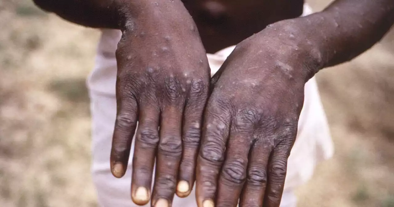 Two probable monkeypox cases detected in Utah