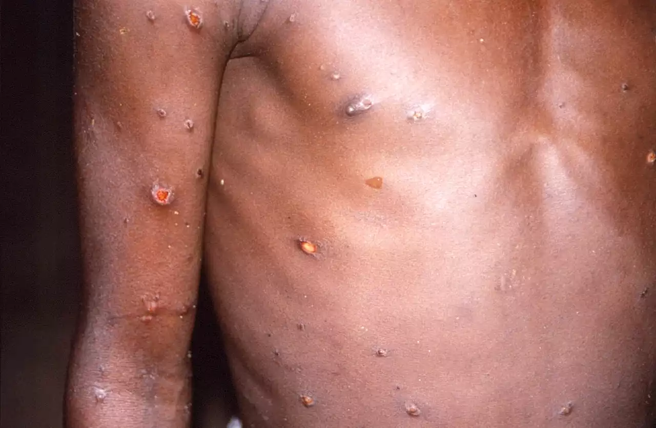 Monkeypox outbreak is not as serious as Covid, says minister