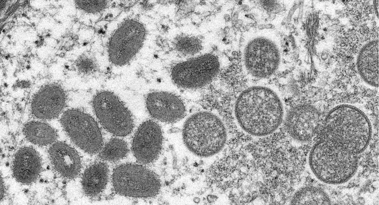 CDC believes NYC monkeypox case is real, says 5 incidents overall in US